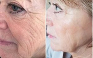 wrinkle reduction treatment