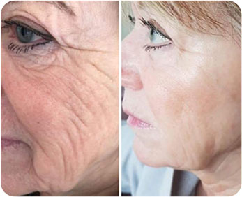 Age-Defying Secrets: The Best Treatments for Wrinkle Reduction