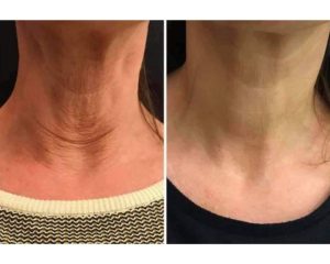 full neck lift